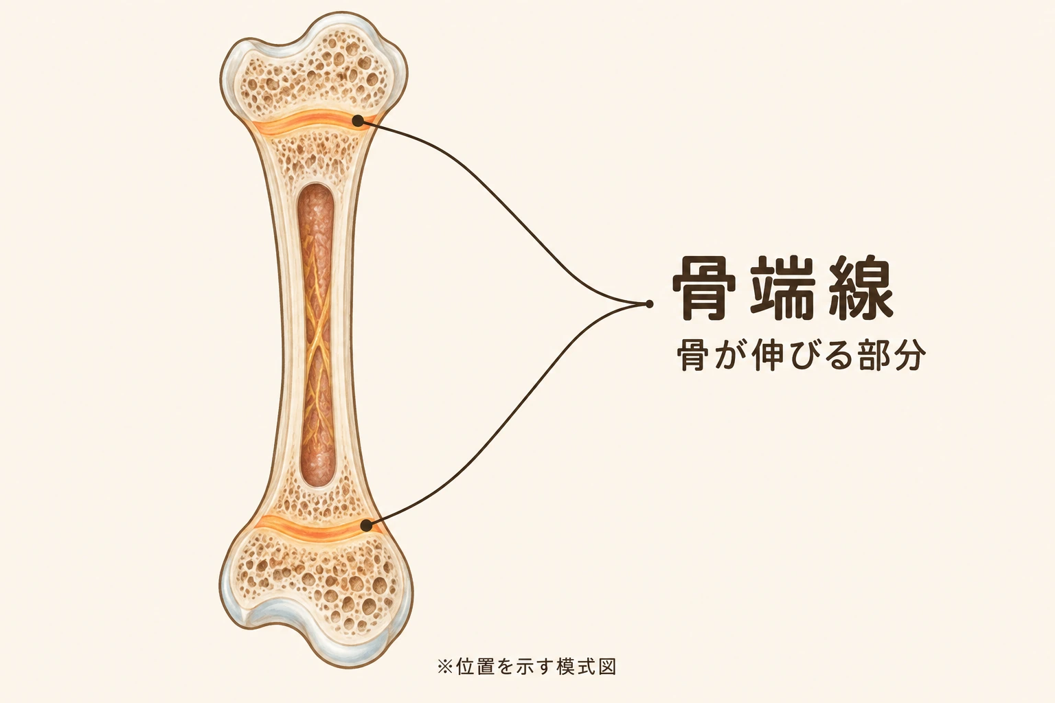 成長期の長い骨の模式図。骨の両端に近い骨端線をオレンジ色で示しています。骨端線は骨が伸びる部分です。